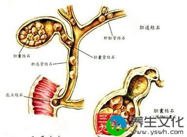 急性结石性胆囊炎