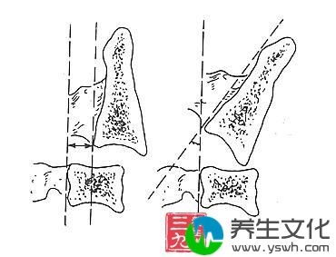 颈椎骨折脱位