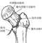 股骨干骨折