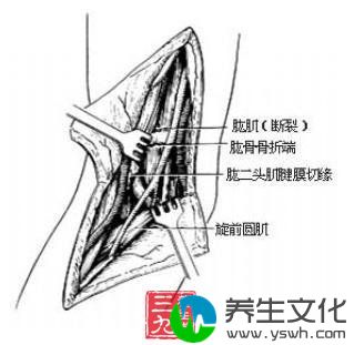 肱骨髁上骨折