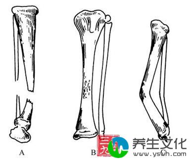 先天性胫骨假关节