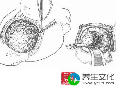 额叶肿瘤