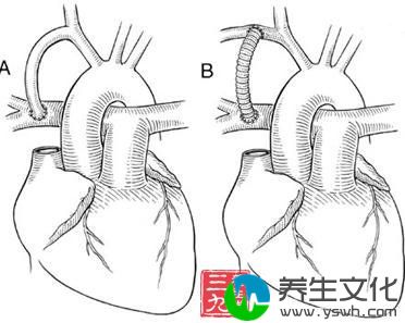 法乐四联症