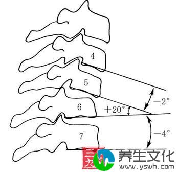 颈椎半脱位