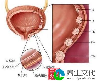 膀胱肿瘤