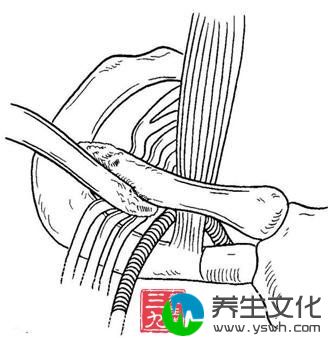 胸廓出口综合征