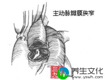 主动脉瓣膜部狭窄