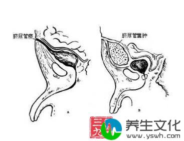 脐尿管囊肿