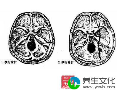 颞骨骨折