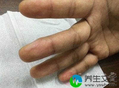 如果右手的无名指明显长于食指，那么患前列腺癌的危险就比较大