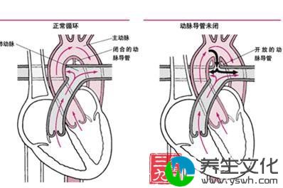 先天性动脉导管未闭