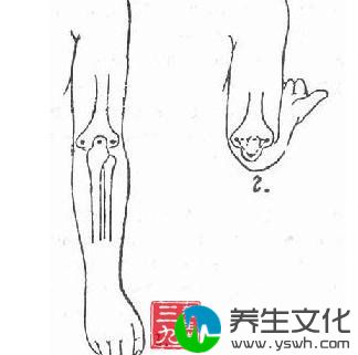 尺骨鹰嘴骨折