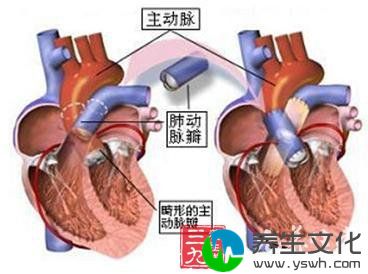 先天性主动脉瓣病变