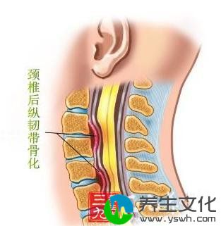 颈椎后纵韧带骨化症