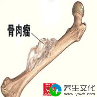 中心性软骨肉瘤