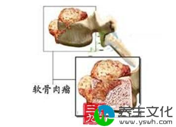 反分化软骨肉瘤