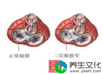 风湿性单独三尖尖瓣狭窄