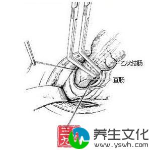 直肠损伤