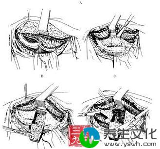 骶髂关节结核