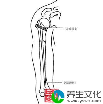 肱骨内髁骨折