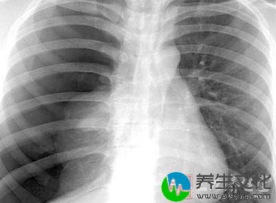 接受X线诊断、原子弹爆炸的人群白血病发生率高