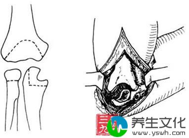 肘关节强直