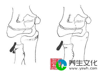 桡骨小头骨骺分离