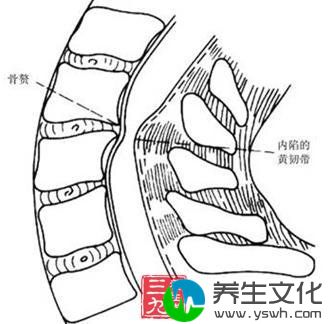 黄韧带增生