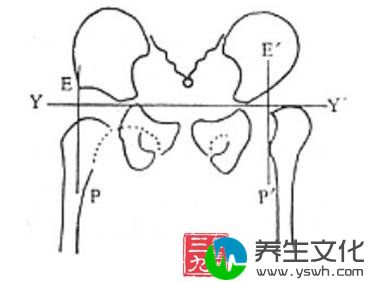 先天性髋关节脱位