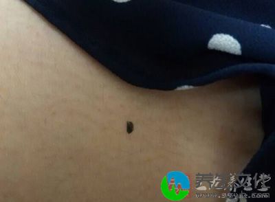 男女长了这颗痣都需要小心遭人暗算，经常遭遇突发事件