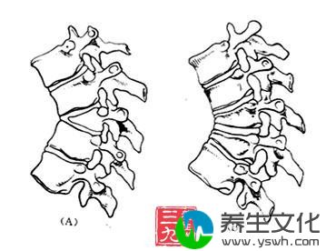 先天性椎体畸形