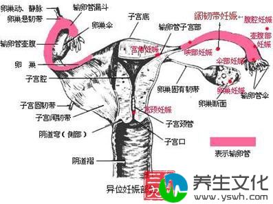 输卵管妊娠