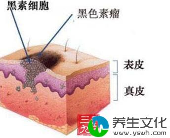 恶性黑色素瘤