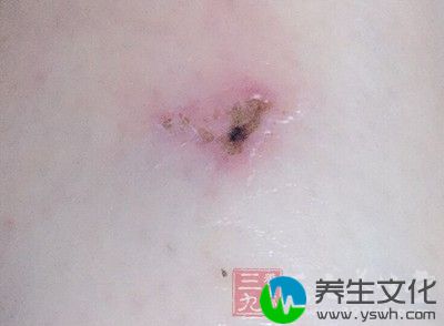 王女士腋下的部位已经开始结痂