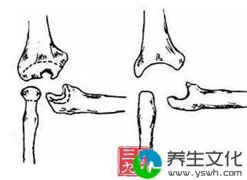 局限性脓肿