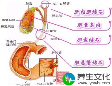 胆黄疾病