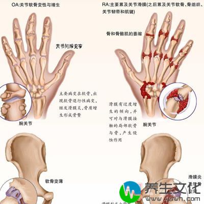 患者患有类风湿关节炎、糖尿病、甲状腺功能低下，则必须首先积极治疗原发病