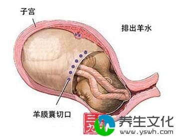 羊水量少