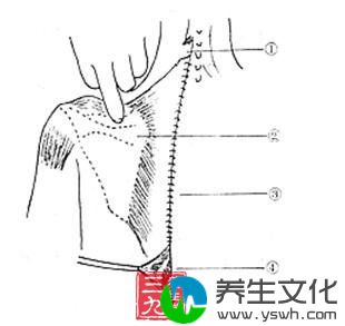 先天性高肩胛症