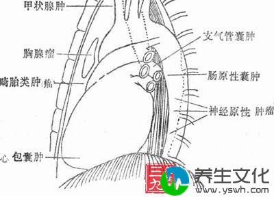 原发性纵隔肿瘤