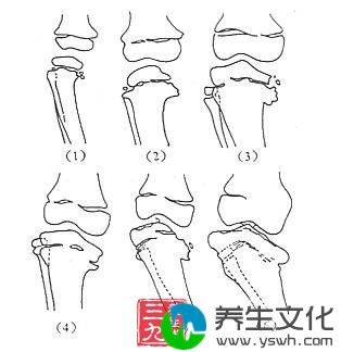 胫骨内髁骨软骨病