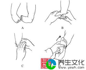 先天性仰趾外翻足