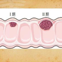 昆布石莲汤治疗大肠癌