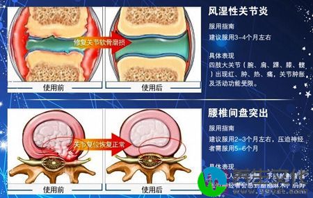 大多数人表现为腰，下肢放射疼痛，压迫神经者会感到退步麻木，肌力下降