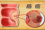 直肠癌的症状表现有哪些 直肠癌该怎么预防好