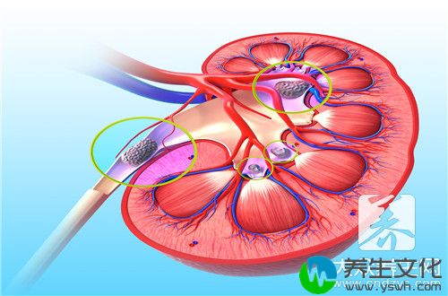 男人肾结石怎么治