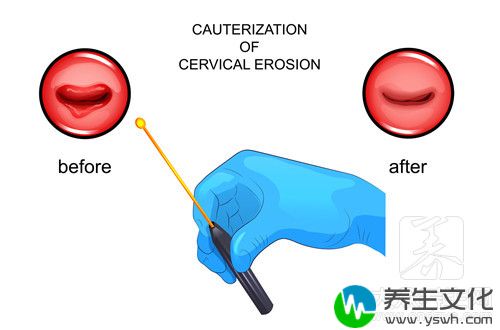  彩超左侧附件区囊肿