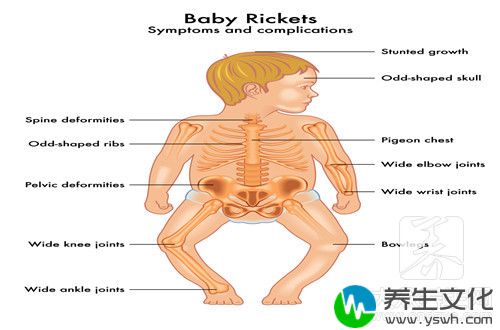 三岁宝宝佝偻病怎么办