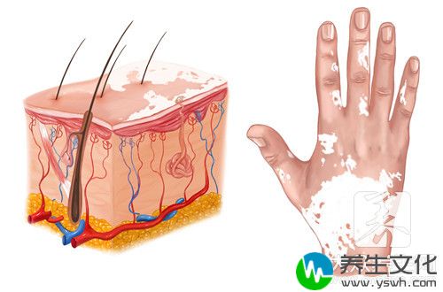  孩子身上有一块白斑