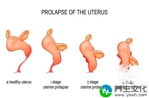  子宫前倾的危害